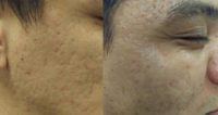 35-44 year old man treated with Acne Scars Treatment