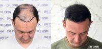 35-44 year old man treated with FUE Hair Transplant