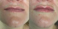 35-44 year old woman treated with Lip Augmentation