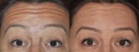 35-44 year old woman treated with Botox