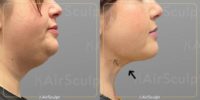 35-44 year old woman treated with AirSculpt