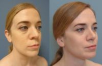 35-44 year old woman treated with Rhinoplasty