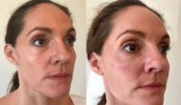 35-44 year old woman treated with Injectable Fillers