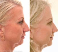 35-44 year old woman treated with Rhinoplasty