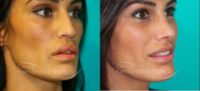 35-44 year old woman treated with Lip Surgery
