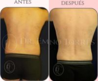 35-44 year old man treated with Liposculpture