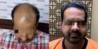 35-44 year old man treated with FUE Hair Transplant