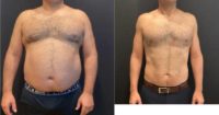35-44 year old man treated with Ozempic for Weight Loss