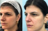 35-44 year old woman treated with Lip Fillers