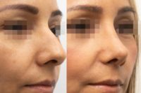 35-44 year old woman treated with Rhinoplasty