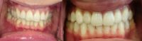 35-44 year old woman treated with Invisalign