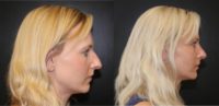 35-44 year old woman treated with Rhinoplasty