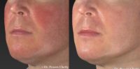 35-44 year old man treated with Rosacea Treatment