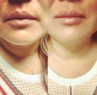 35-44 year old woman treated with Lip Augmentation