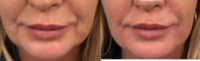 44 year old woman treated with Injectable Fillers to jawline and NLF