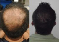 45 year old man treated with Hair Transplant