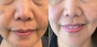 45-54 year old woman treated with Melasma Treatment