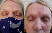 45-54 year old woman treated with Laser Resurfacing