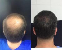 45-54 year old man treated with FUE Hair Transplant