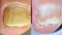 45-54 year old man treated with Laser Toenail Fungus Removal