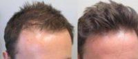 45-54 year old man treated with Hair Loss Treatment