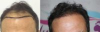 45-54 year old man treated with Hair Transplant