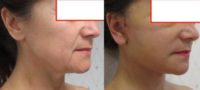 45-54 year old woman treated with Facelift