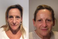 45-54 year old woman treated with Liquid Facelift