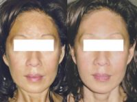 50 year old woman treated with Pico Laser Treatment on Pigmentation