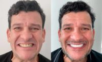 45-54 year old man treated with Dental Crown for a complete smile makeover