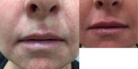 45-54 year old woman treated with Lip Augmentation