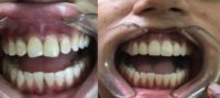 45-54 year old woman treated with Smile Makeover