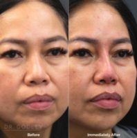 45-54 year old woman treated with Nonsurgical Nose Job, Thread Lift