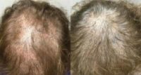 45-54 year old woman treated with Hair Loss Treatment