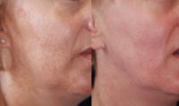 45-54 year old woman treated with Melasma Treatment