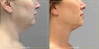 45-54 year old woman treated with AirSculpt