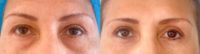 55-64 year old woman treated with Eyelid Surgery, Brow Lift