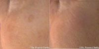 55-64 year old woman treated with Mole Removal