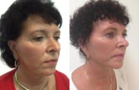 55-64 year old woman treated with Facelift