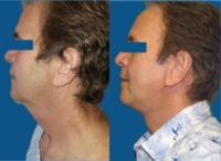 55-64 year old man treated with Facelift