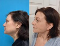 55-64 year old woman treated with Facelift, Eyelid Surgery