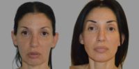 55-64 year old woman treated with Deep Plane Facelift