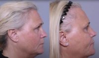 55-64 year old woman treated with Injectable Fillers