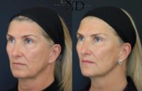 55-64 year old woman treated with Juvederm