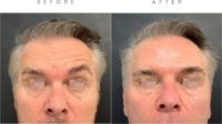 55-64 year old man treated with Botox