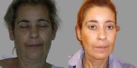 55-64 year old woman treated with Deep Plane Facelift