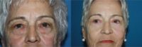 55-64 year old woman treated with Eyelid Surgery