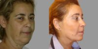 55-64 year old woman treated with Deep Plane Facelift