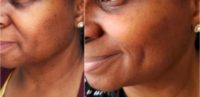 61 year old African woman treated with Fotona Er-YAG Laser for Dermatosis papulosa nigra (DPN).