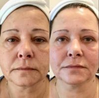 55-64 year old woman treated with Voluma